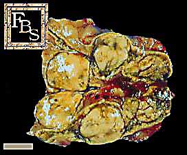 nodular cortical hyperplasia of adrenal gland.jpg
